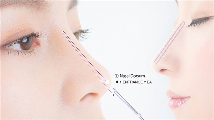 لیفت بینی با نخ؛ اصلاح فرم سریع و ماندگار