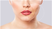 موثرترین روش از بین بردن جای اسکار پوست